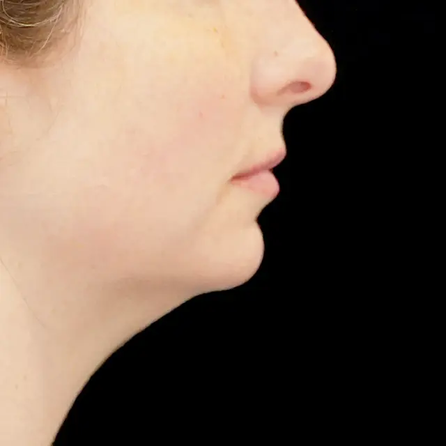 Chin Implant before at Fulcrum Aesthetics and Surgery in Chicago, IL