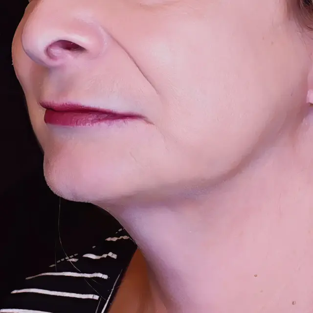 Facelift after at Fulcrum Aesthetics and Surgery in Chicago, IL