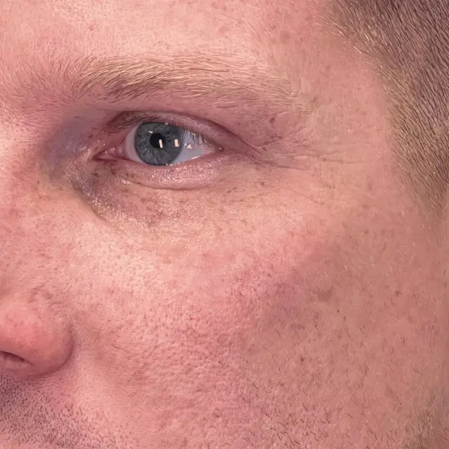 Laser Skin Resurfacing after at Fulcrum Aesthetics and Surgery in Chicago, IL