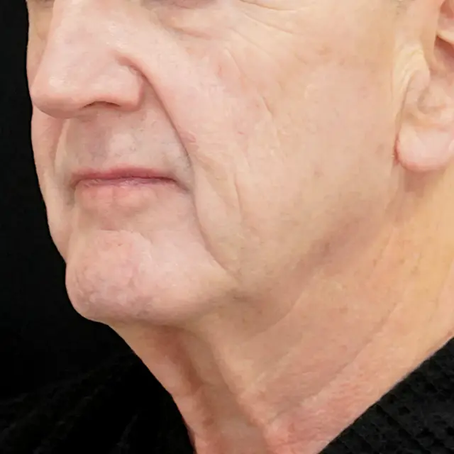 Facelift before at Fulcrum Aesthetics and Surgery in Chicago, IL
