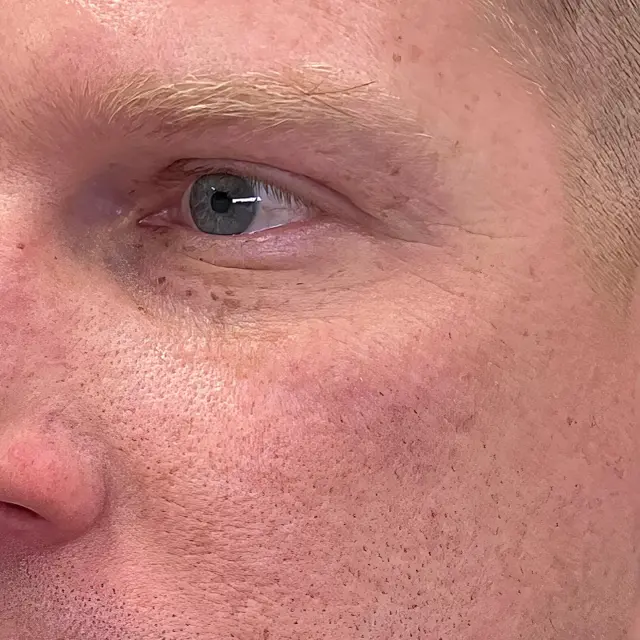 Laser Skin Resurfacing before at Fulcrum Aesthetics and Surgery in Chicago, IL