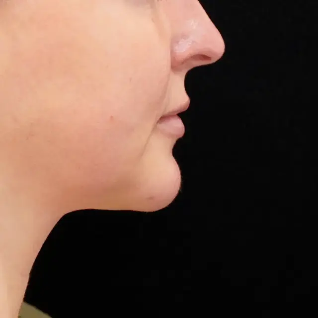 Chin Implant after at Fulcrum Aesthetics and Surgery in Chicago, IL
