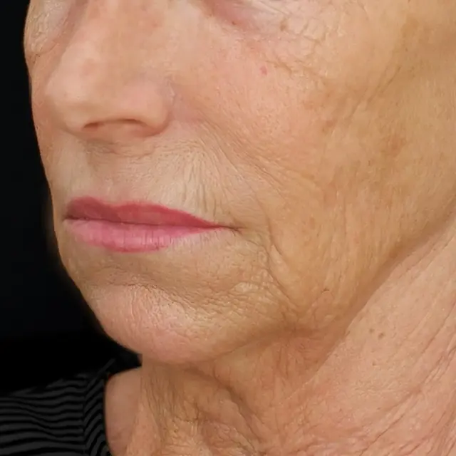 Facelift before at Fulcrum Aesthetics and Surgery in Chicago, IL