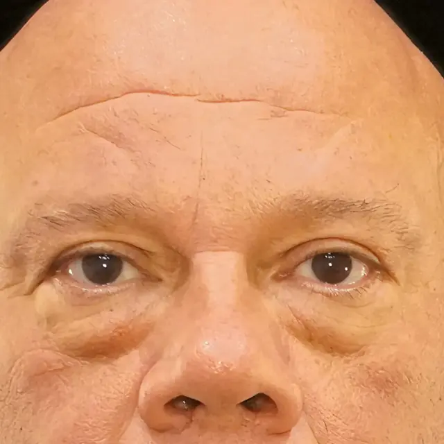 Blepharoplasty before at Fulcrum Aesthetics and Surgery in Chicago, IL