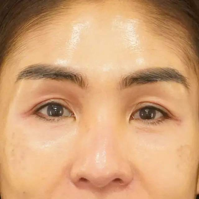 Blepharoplasty before at Fulcrum Aesthetics and Surgery in Chicago, IL