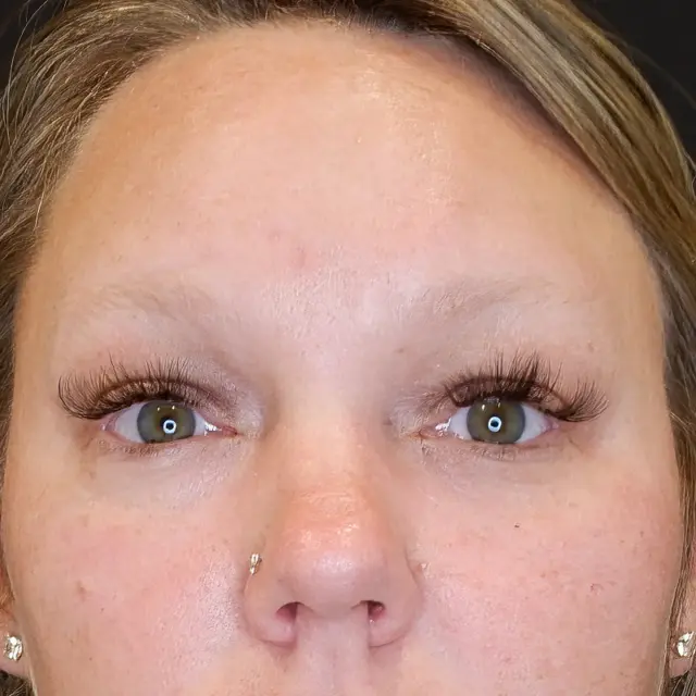 Blepharoplasty after at Fulcrum Aesthetics and Surgery in Chicago, IL