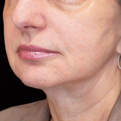 Fulcrum Aesthetics and Surgery facelift after — Chicago, IL