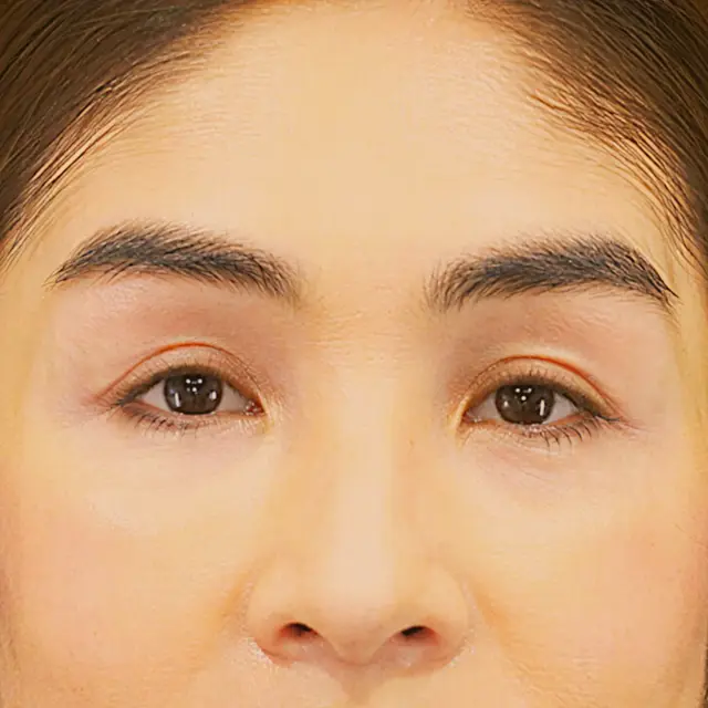 Blepharoplasty after at Fulcrum Aesthetics and Surgery in Chicago, IL