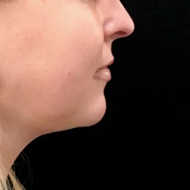 Chin Implant before at Fulcrum Aesthetics and Surgery in Chicago, IL