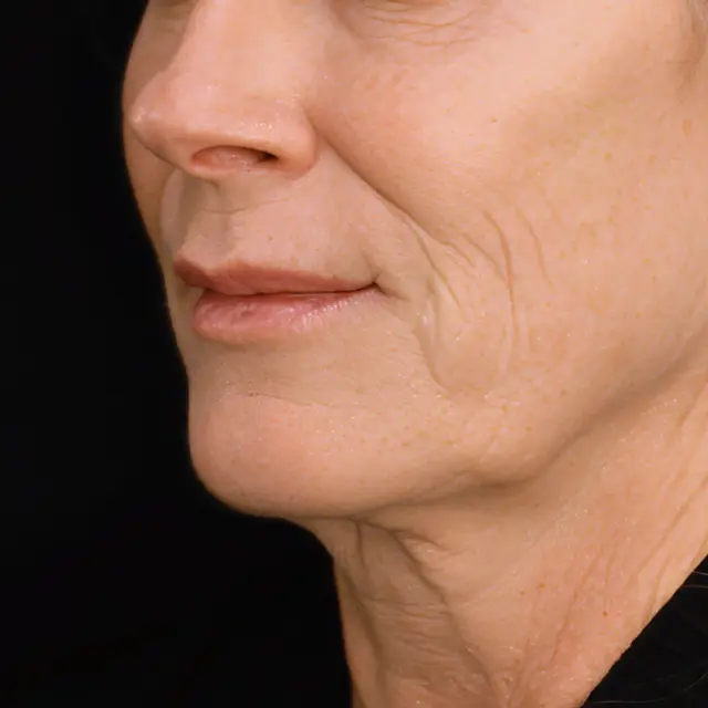 Facelift before at Fulcrum Aesthetics and Surgery in Chicago, IL