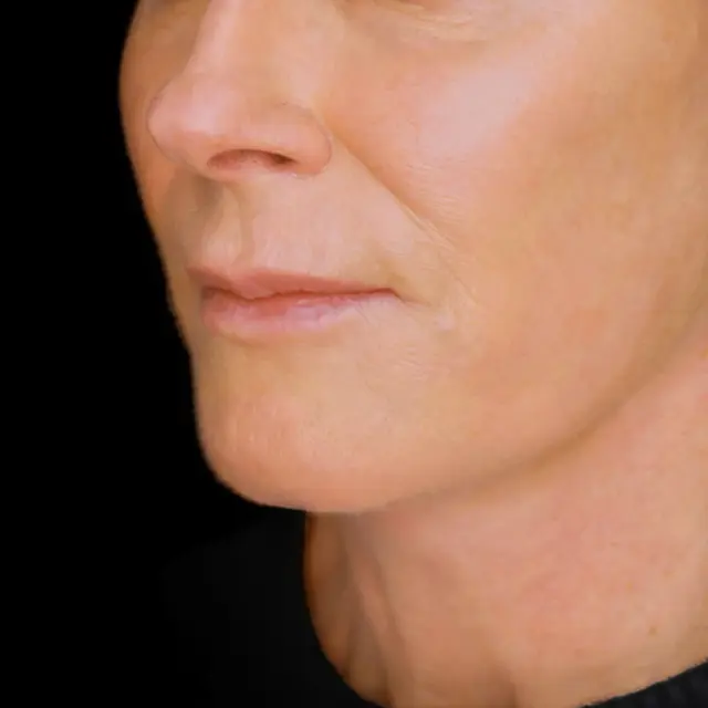 Facelift after at Fulcrum Aesthetics and Surgery in Chicago, IL