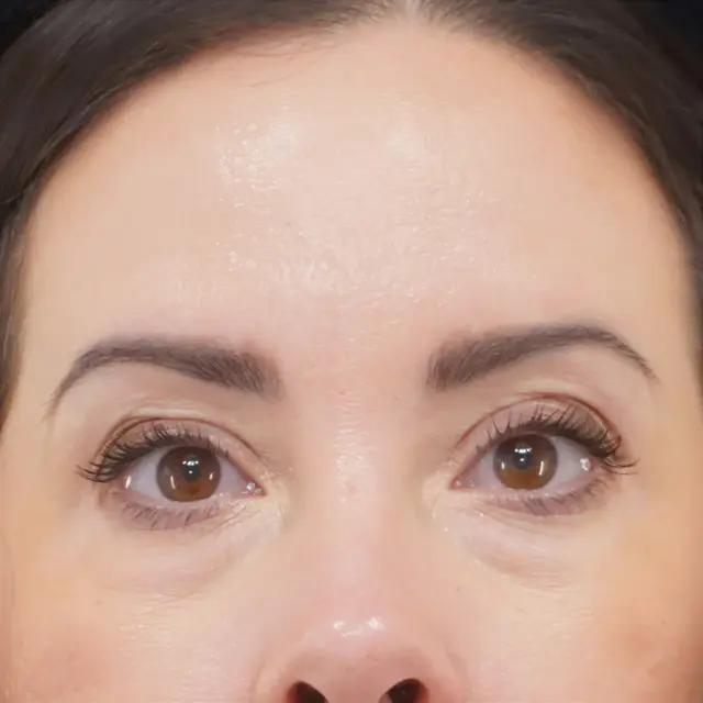 Blepharoplasty before at Fulcrum Aesthetics and Surgery in Chicago, IL
