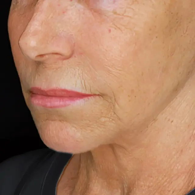 Facelift after at Fulcrum Aesthetics and Surgery in Chicago, IL