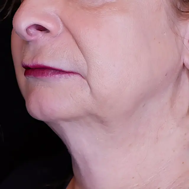 Facelift before at Fulcrum Aesthetics and Surgery in Chicago, IL