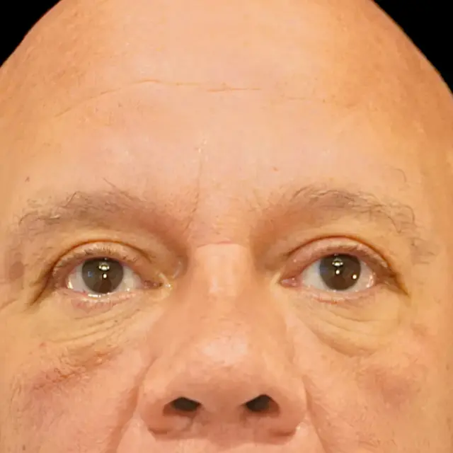 Blepharoplasty after at Fulcrum Aesthetics and Surgery in Chicago, IL