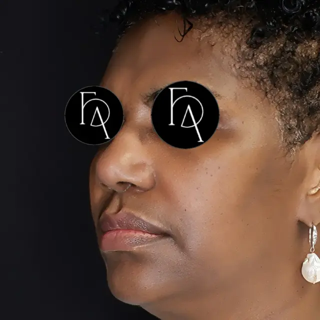 Fat Transfer before at Fulcrum Aesthetics and Surgery in Chicago, IL