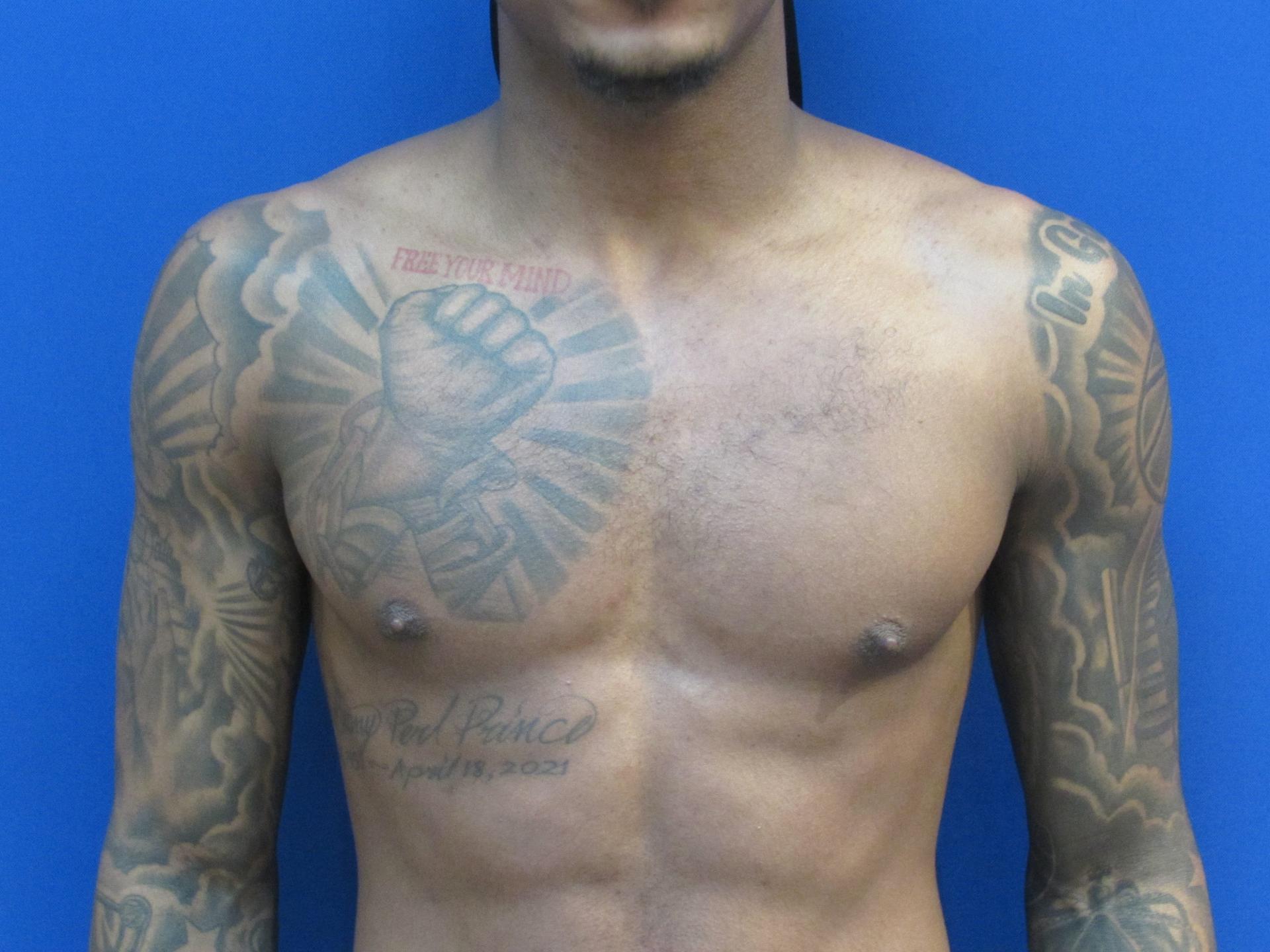 Garber Plastic Surgery gynecomastia after — Cherry Hill Township, NJ