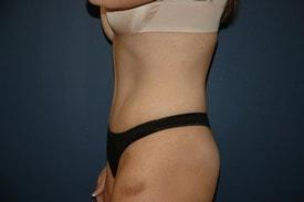 Garber Plastic Surgery tummy tuck after — Cherry Hill Township, NJ