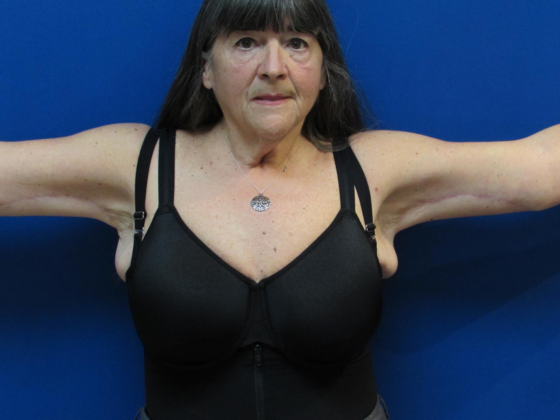 Garber Plastic Surgery arm lift after — Cherry Hill Township, NJ