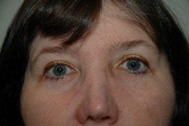 Garber Plastic Surgery eyelid lift after — Cherry Hill Township, NJ