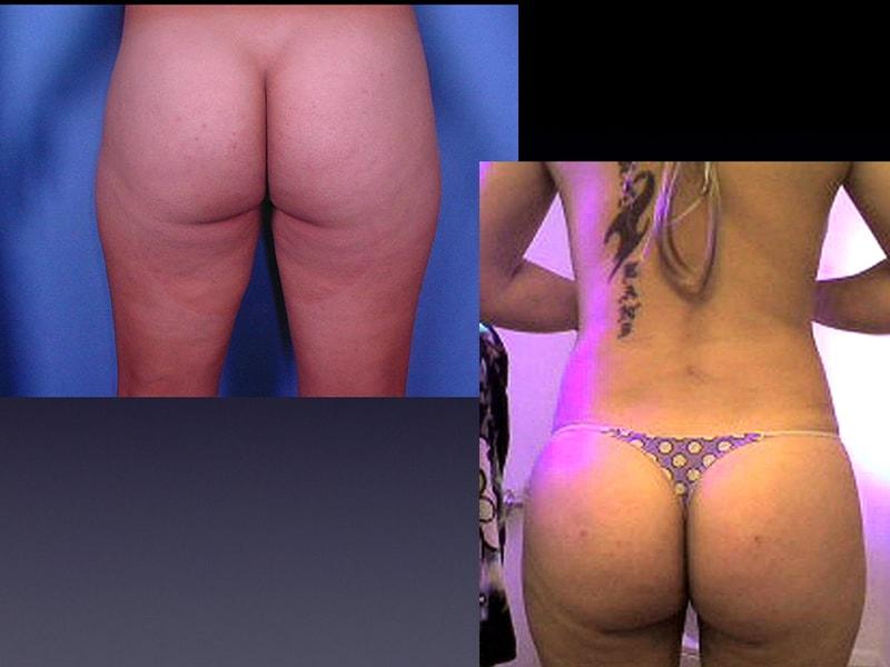 The Zukowski Center For Cosmetic Plastic Surgery body contouring result — Wilmette, IL