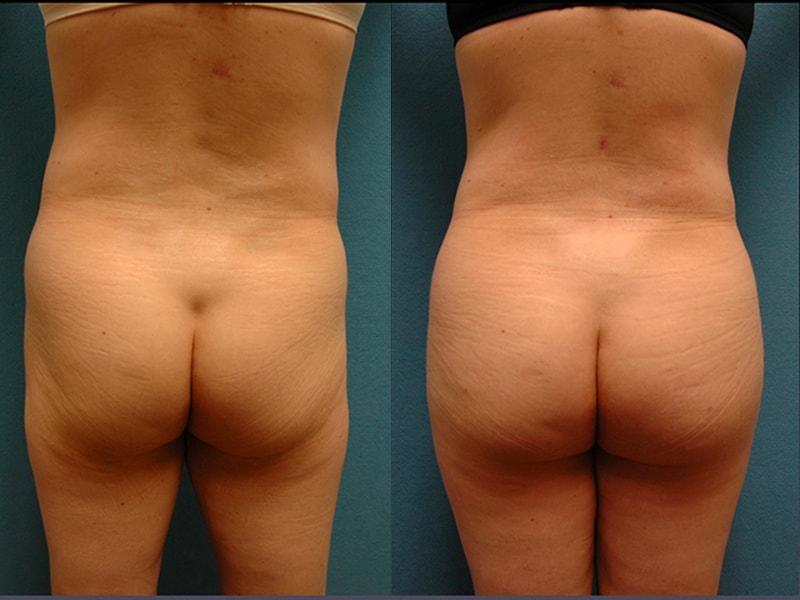 The Zukowski Center For Cosmetic Plastic Surgery body contouring result — Wilmette, IL