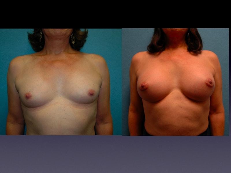 The Zukowski Center For Cosmetic Plastic Surgery breast augmentation result — Wilmette, IL