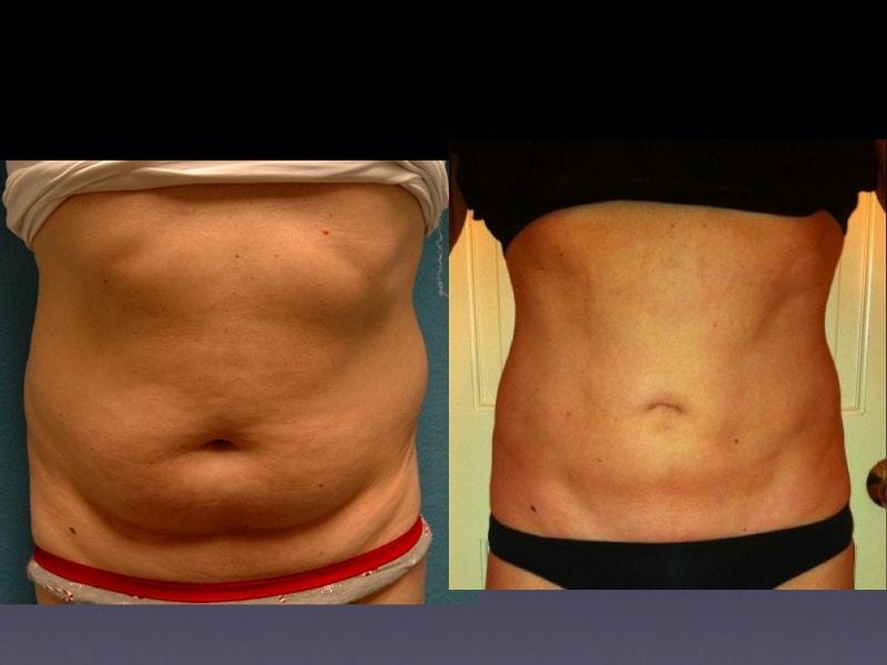 The Zukowski Center For Cosmetic Plastic Surgery body contouring result — Wilmette, IL