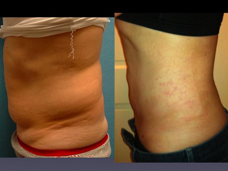 The Zukowski Center For Cosmetic Plastic Surgery body contouring result — Wilmette, IL