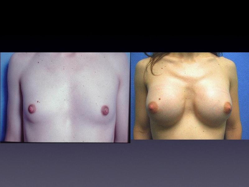 The Zukowski Center For Cosmetic Plastic Surgery breast augmentation result — Wilmette, IL