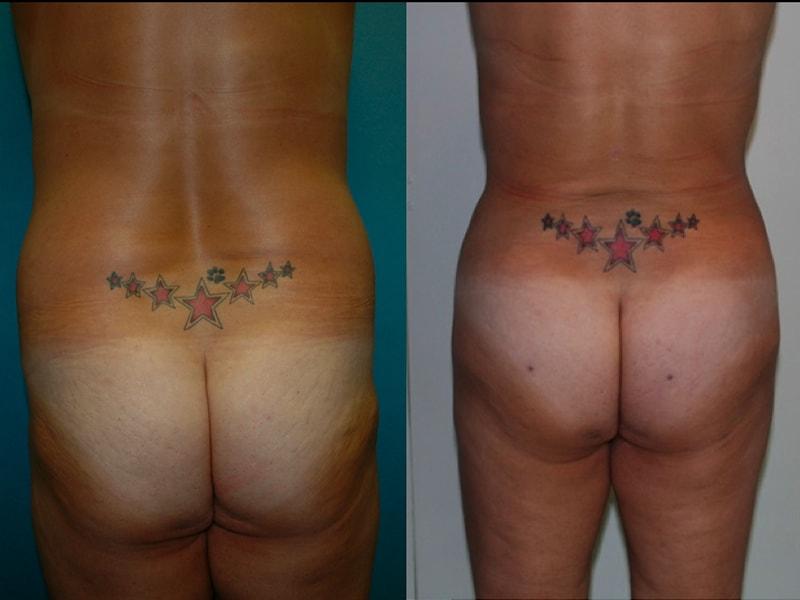 The Zukowski Center For Cosmetic Plastic Surgery body contouring result — Wilmette, IL