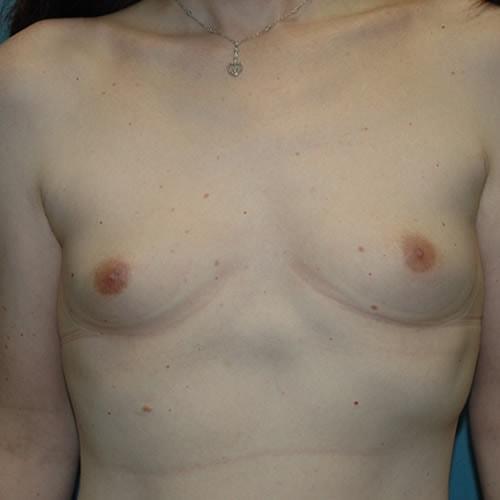 Breast Augmentation before at The Zukowski Center For Cosmetic Plastic Surgery in Wilmette, IL
