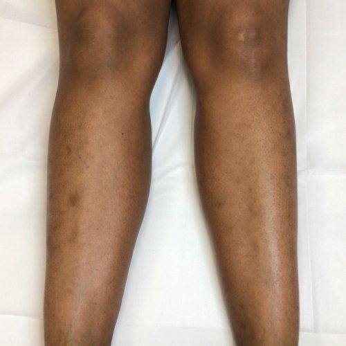NIMS Medspa laser treatment after — Houston, TX