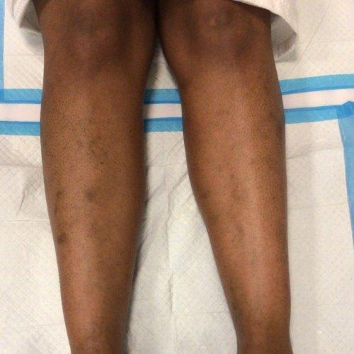 Chemical Peel before at NIMS Medspa in Houston, TX