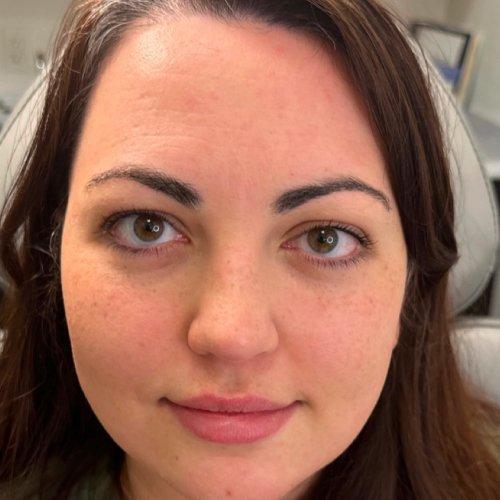 Lip Filler before at NIMS Medspa in Houston, TX