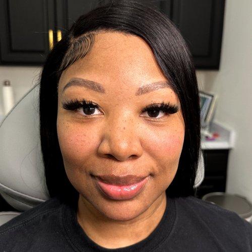 Lip Filler after at NIMS Medspa in Houston, TX
