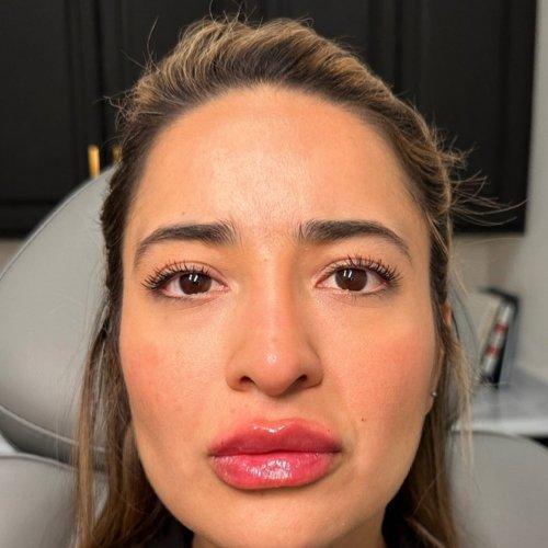 Lip Filler after at NIMS Medspa in Houston, TX