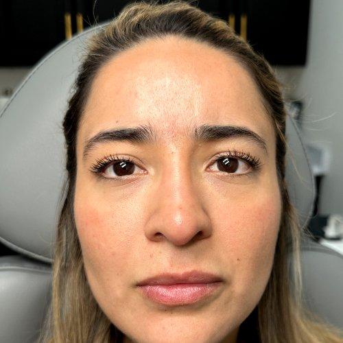 Lip Filler before at NIMS Medspa in Houston, TX