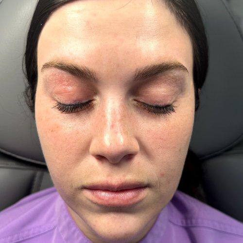 NIMS Medspa botox after — Houston, TX