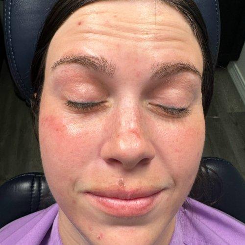 Botox before at NIMS Medspa in Houston, TX