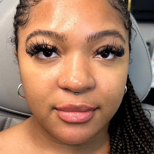 Lip Filler after at NIMS Medspa in Houston, TX