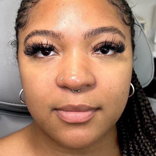 Lip Filler before at NIMS Medspa in Houston, TX