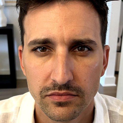 Botox after at NIMS Medspa in Houston, TX