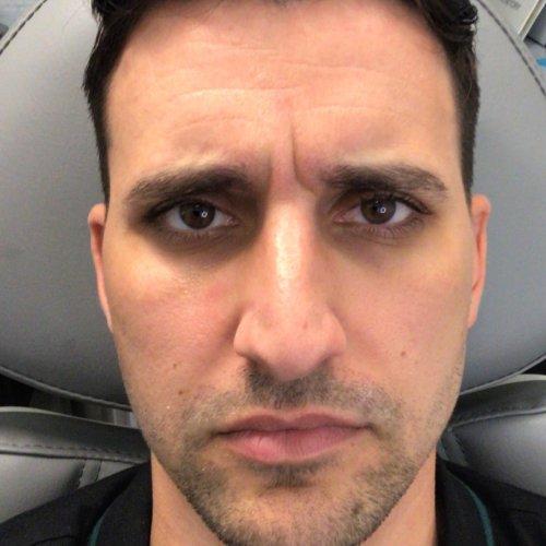 Botox before at NIMS Medspa in Houston, TX