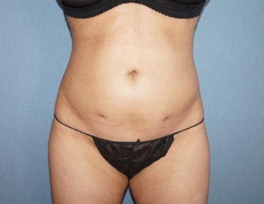 Eliopoulos Plastic Surgery & MedSpa liposuction after — Chelmsford, MA