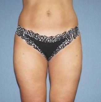 Eliopoulos Plastic Surgery & MedSpa liposuction after — Chelmsford, MA