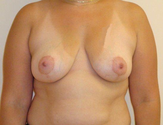 Eliopoulos Plastic Surgery & MedSpa breast reduction after — Chelmsford, MA