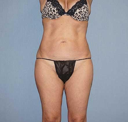 Eliopoulos Plastic Surgery & MedSpa liposuction after — Chelmsford, MA