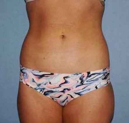 Eliopoulos Plastic Surgery & MedSpa liposuction after — Chelmsford, MA