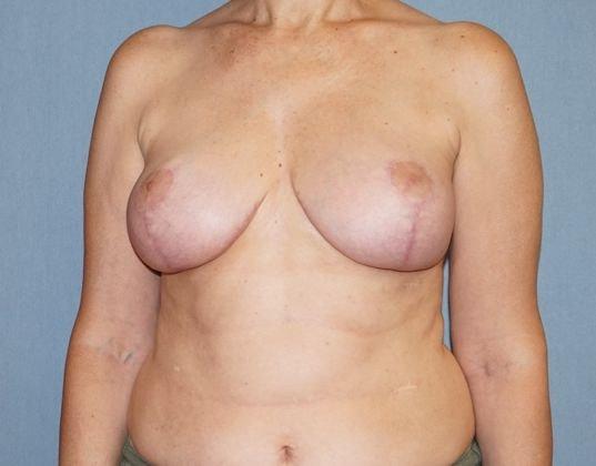Eliopoulos Plastic Surgery & MedSpa breast reduction after — Chelmsford, MA